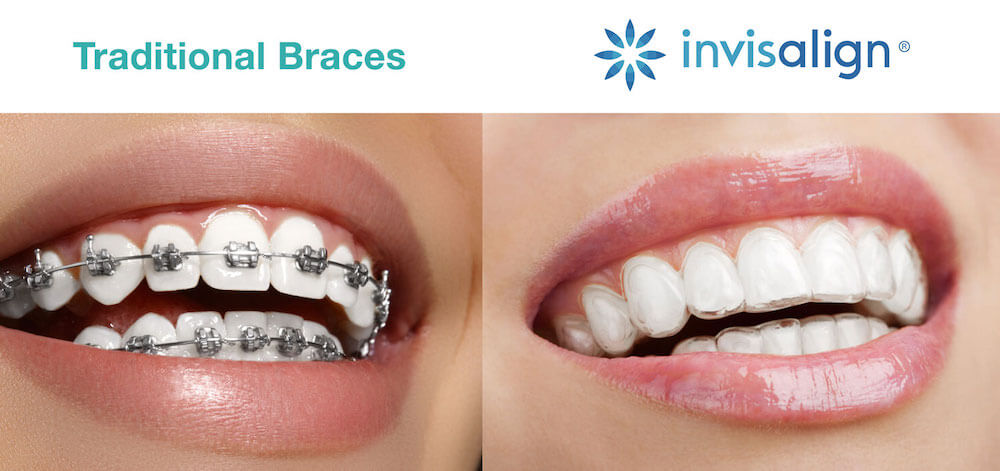 Invisalign vs. Braces Treatments: How Are They Different?