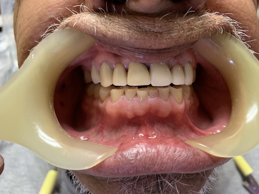 Severe Bruxism Procedure